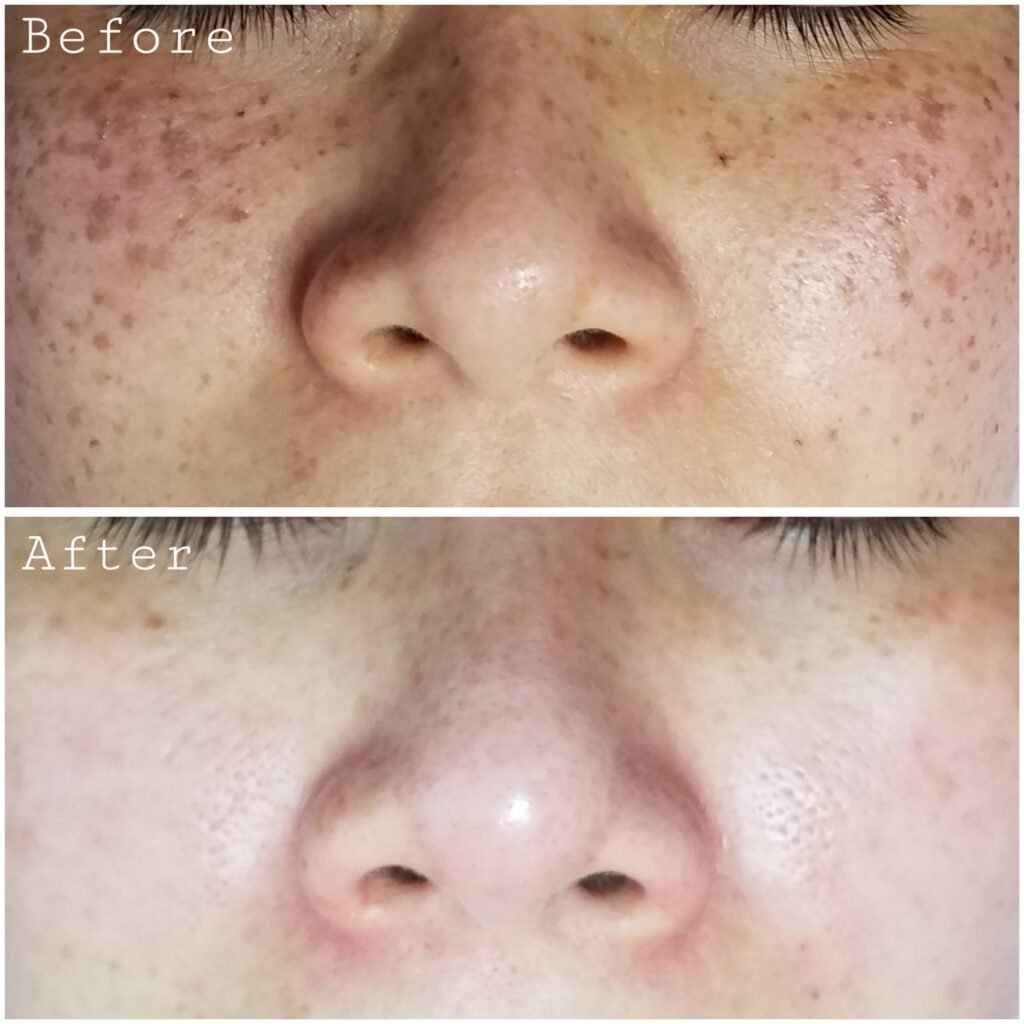 Laser treatment Before & After